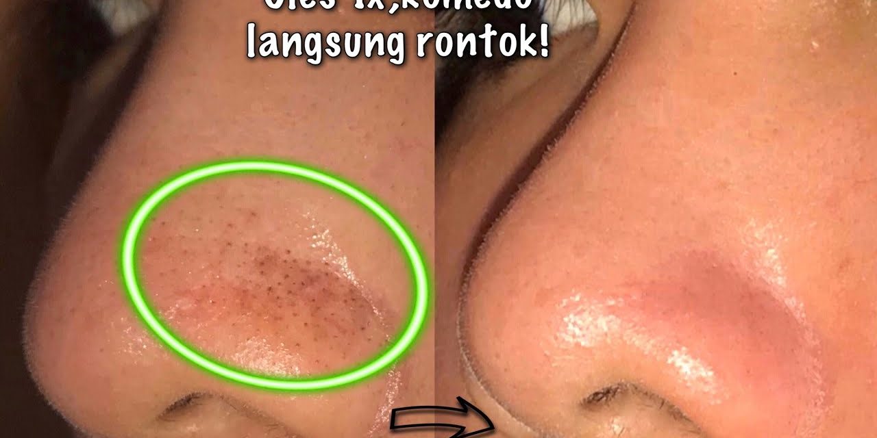 Rahasia Kulit Bersih, Ini Cara Ampuh Mengatasi Komedo Hitammu!