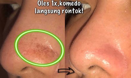 Rahasia Kulit Bersih, Ini Cara Ampuh Mengatasi Komedo Hitammu!