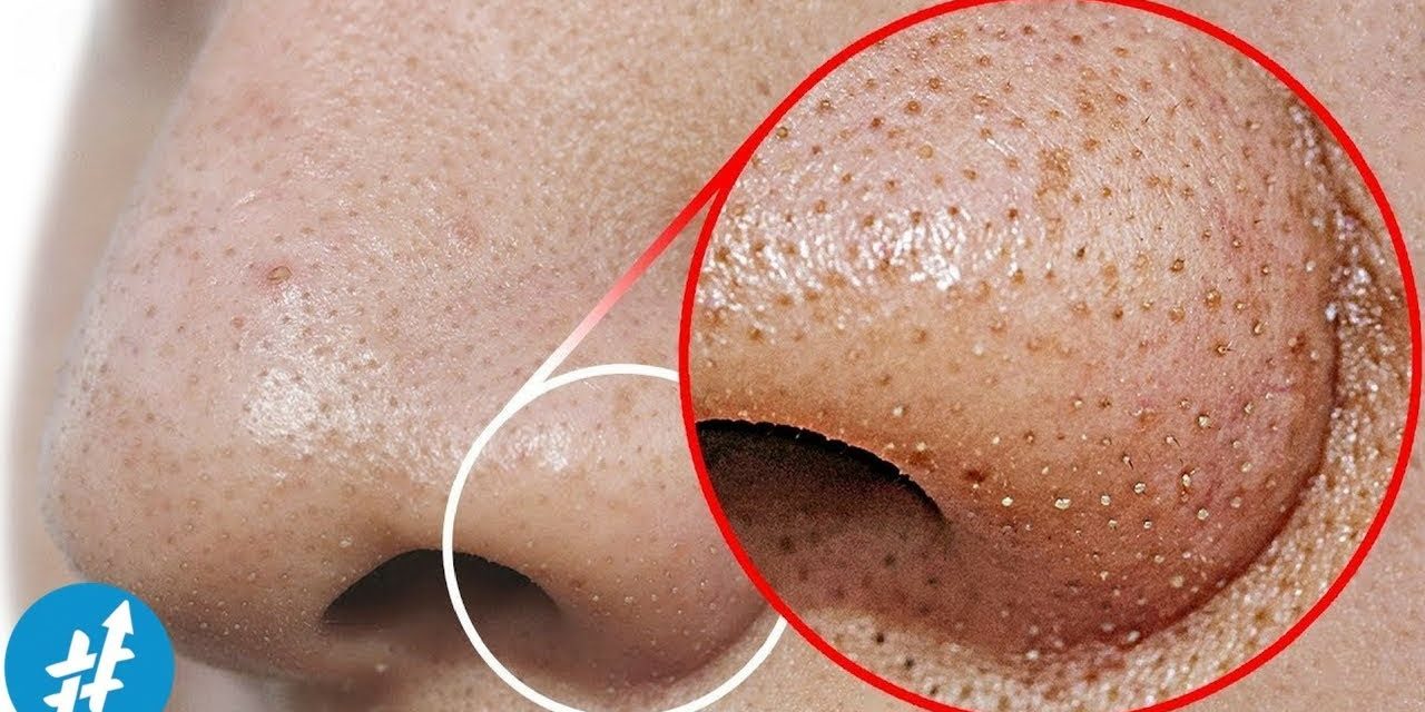 Komedo Hitam Dan Komedo Putih Kini Kerap Menjadi Perhatian
