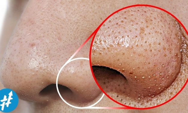Komedo Hitam Dan Komedo Putih Kini Kerap Menjadi Perhatian