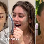 Plastic Surgery, Metode ini Semakin Hits Bagi Yang Berduit