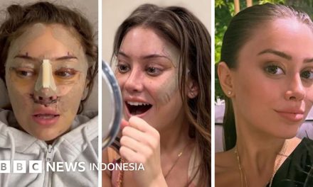 Plastic Surgery, Metode ini Semakin Hits Bagi Yang Berduit