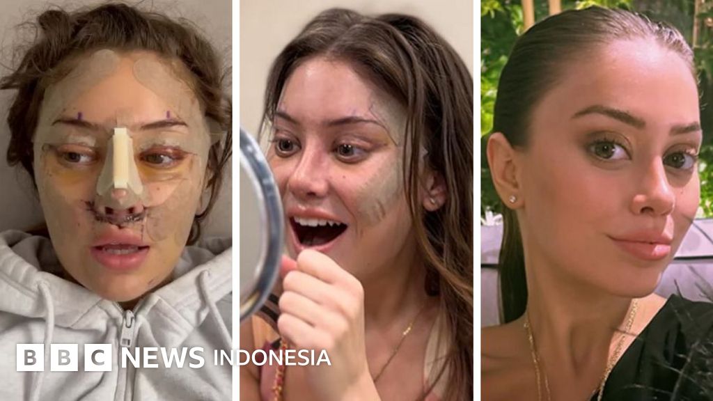 Plastic Surgery, Metode ini Semakin Hits Bagi Yang Berduit